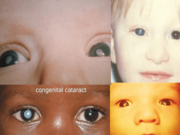 Congenital-cataract