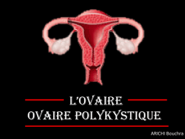 Ovaire polykystique