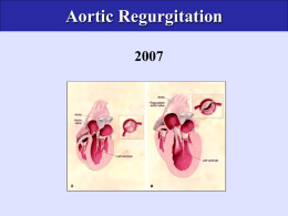 Chronic Aortic Regurgitation
