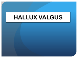 HALLUX VALGUS