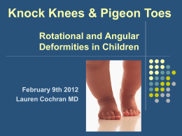 Knock Knees & Pigeon Toes Rotational Deformities