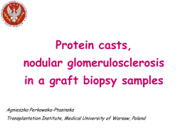 Protein casts, nodular glomerulosclerosis in graft biopsy